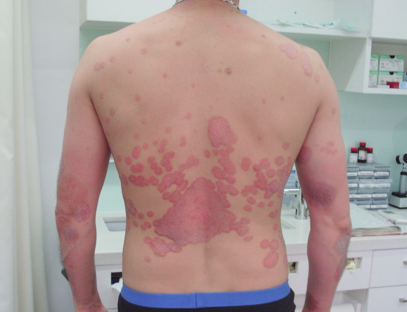 Before image of patient with psoriasis