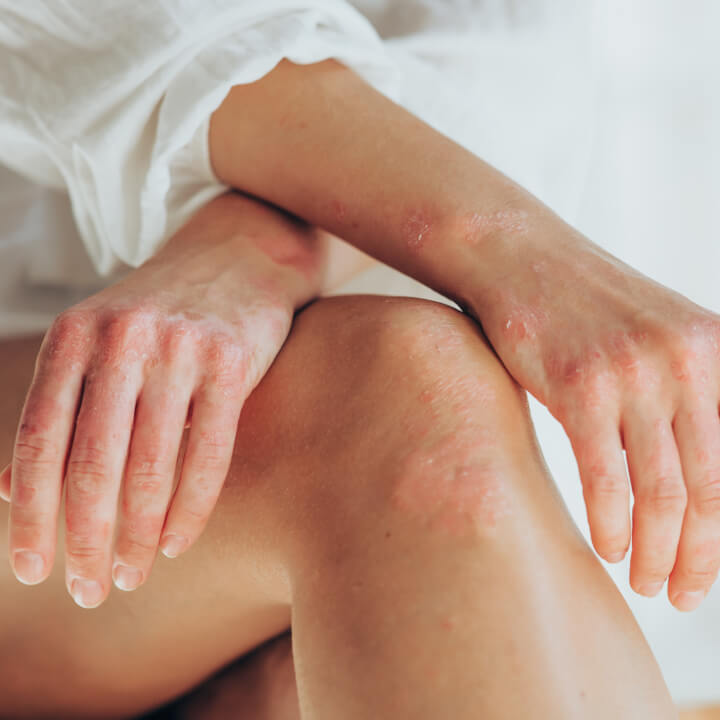 Close-up of person with psoriasis on hands and legs